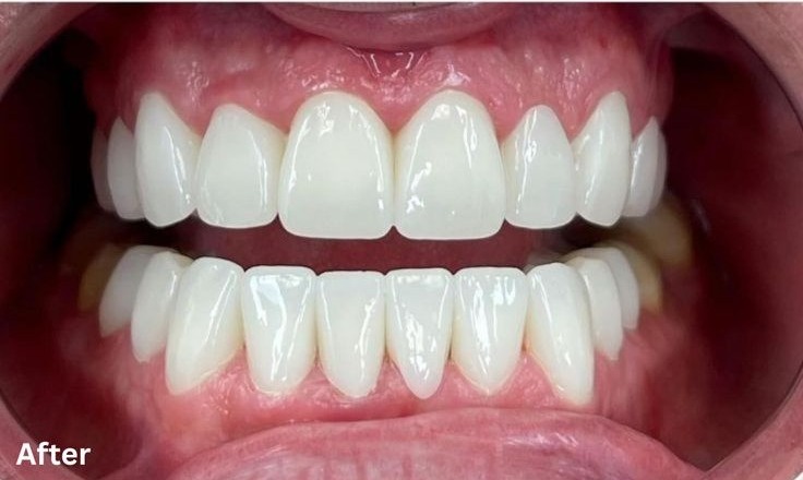 Clear Aligners after treatment