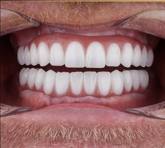 Complete Denture after treatment