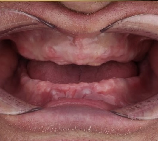 Complete Denture before treatment