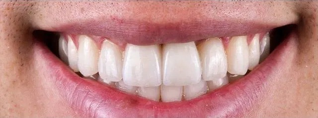 Dental Implant after treatment