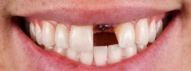 Dental Implant before treatment