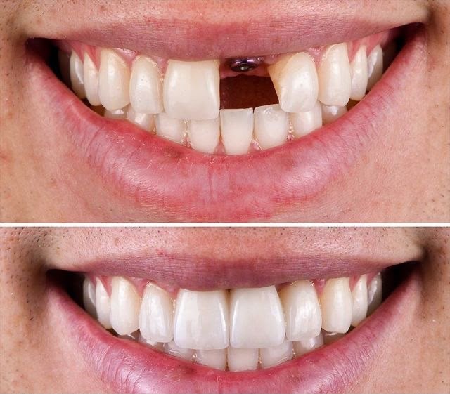Dental Implants