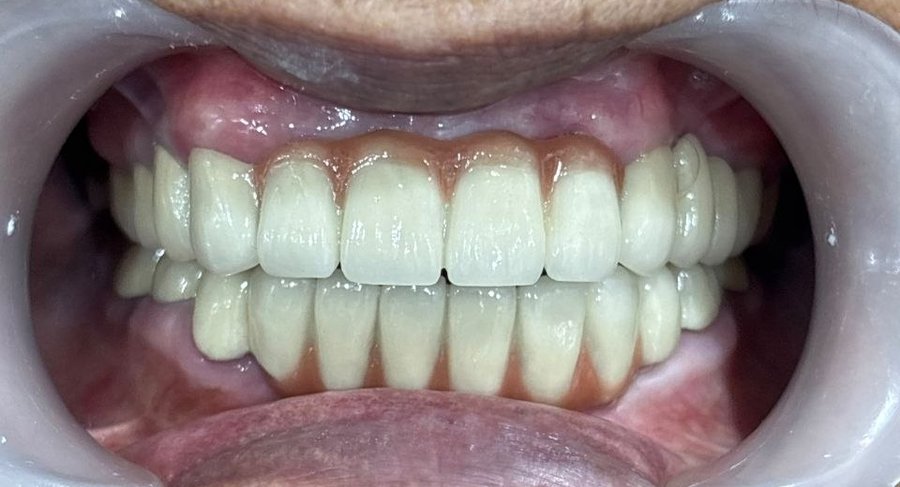 Full Mouth Rehabilitation
