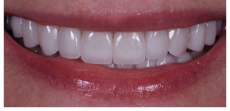 Smile Makeover after treatment