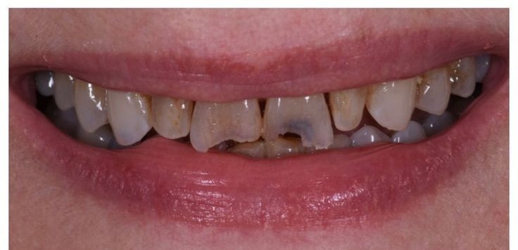 Smile Makeover before treatment
